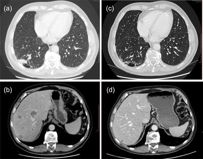 Case Report: Limbic encephalitis following treatment with durvalumab for small-cell lung cancer